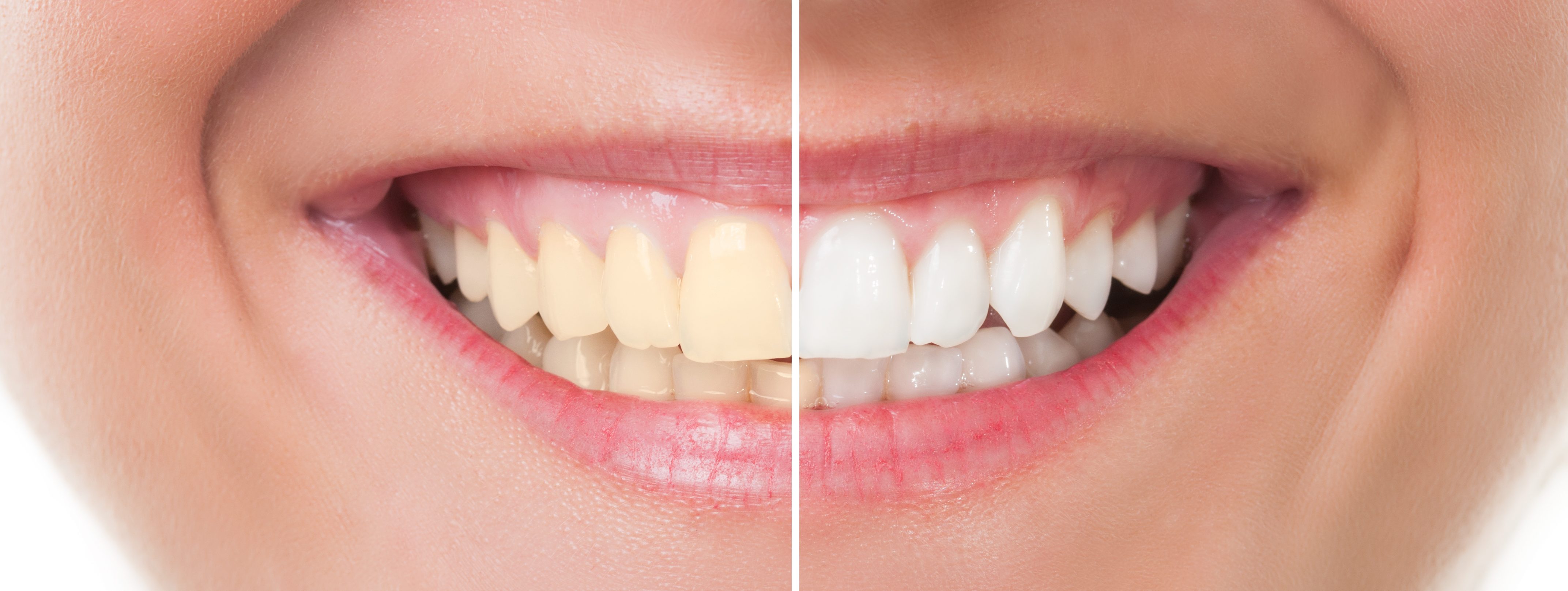 teeth whitening chino